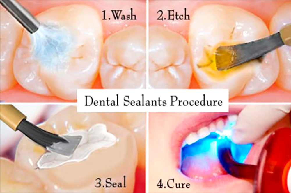 Reducing tooth  decay with sealants