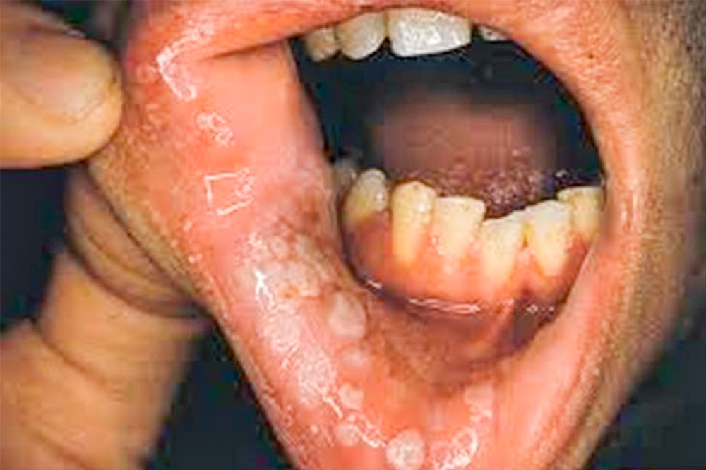 Sexually transmitted diseases that affect the mouth
