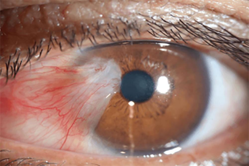 What is a Pterygium and how is it treated?