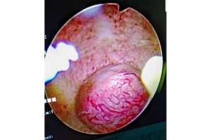 Hysteroscopic Management of Fibroids