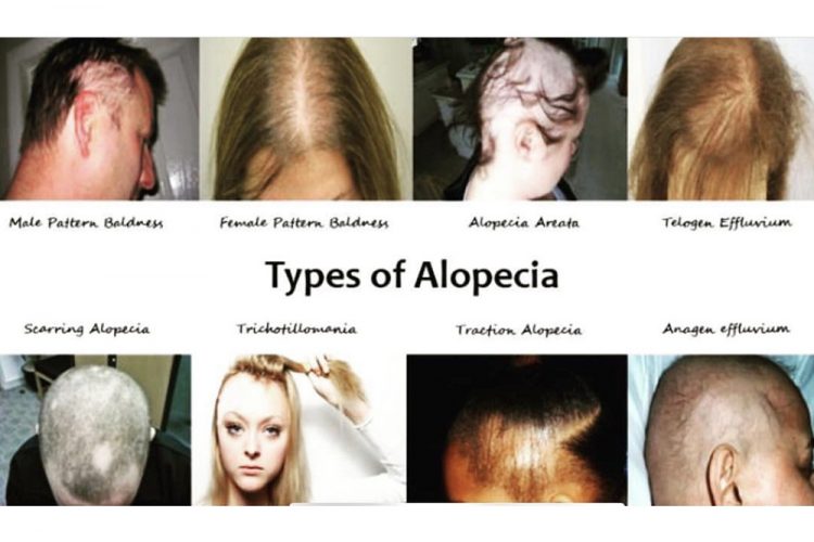 How do I know what type of  Alopecia I have?