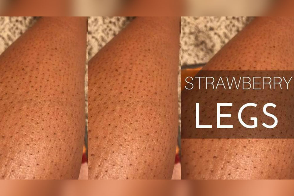 How to get rid of Strawberry legs