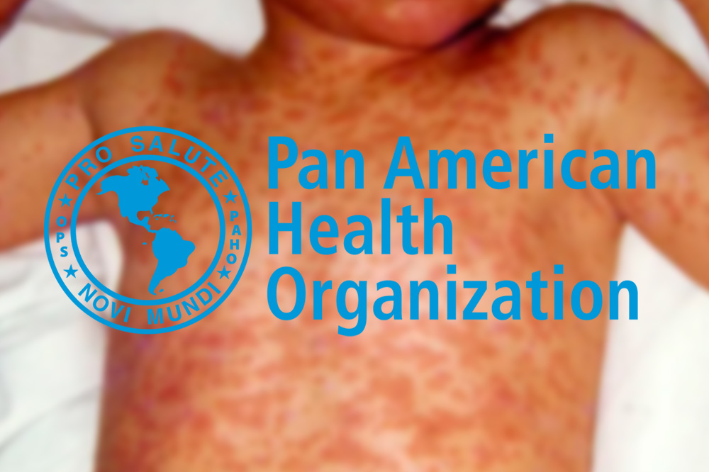 PAHO calls for regional action as the Americas lose measles elimination status