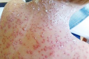 Chickenpox outbreak HMP